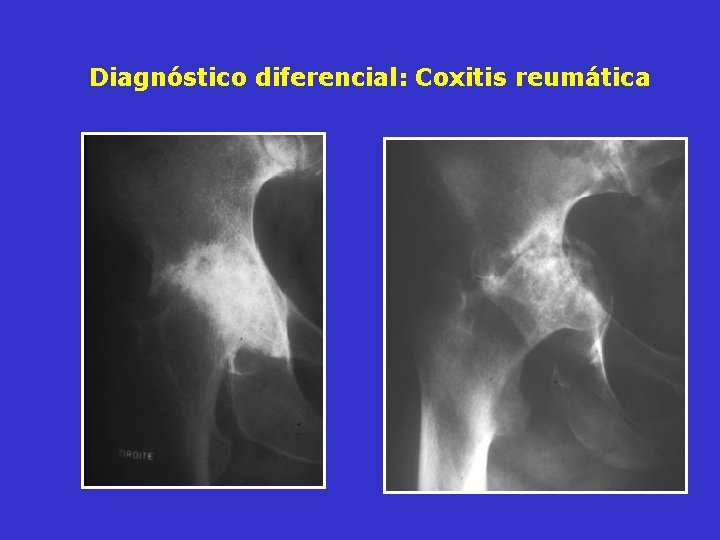 Diagnóstico diferencial: Coxitis reumática Diagnóstico diferencial: Coxitis reumática