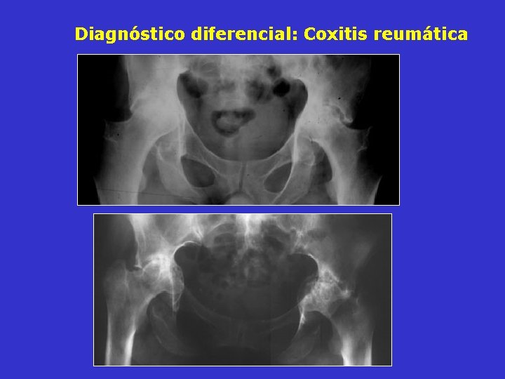 Diagnóstico diferencial: Coxitis reumática Diagnóstico diferencial: Coxitis reumática