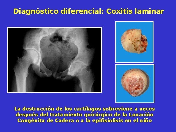 Diagnóstico diferencial: Coxitis laminar La destrucción de los cartílagos sobreviene a veces después del Diagnóstico diferencial: Coxitis laminar La destrucción de los cartílagos sobreviene a veces después del