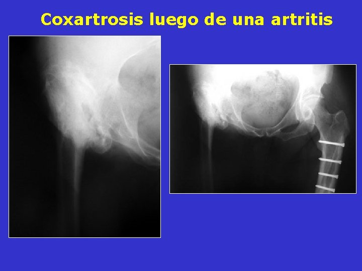 Coxartrosis luego de una artritis Coxartrosis luego de una artritis