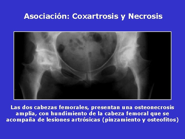 Asociación: Coxartrosis y Necrosis Las dos cabezas femorales, presentan una osteonecrosis amplia, con hundimiento Asociación: Coxartrosis y Necrosis Las dos cabezas femorales, presentan una osteonecrosis amplia, con hundimiento
