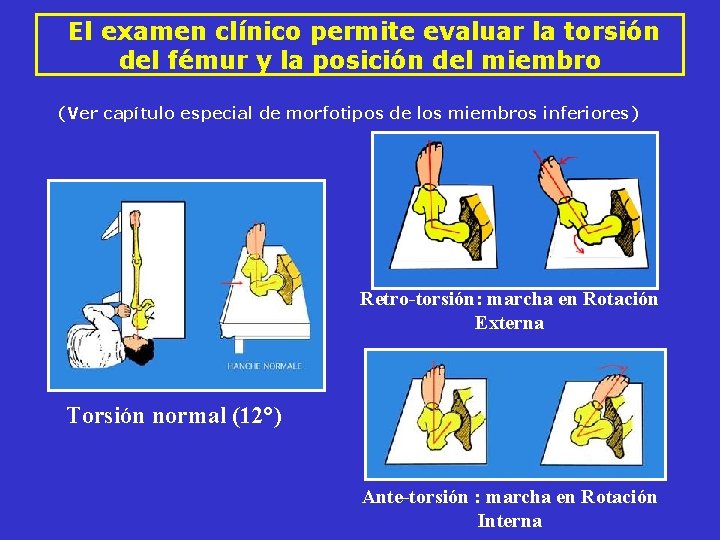 El examen clínico permite evaluar la torsión del fémur y la posición del El examen clínico permite evaluar la torsión del fémur y la posición del