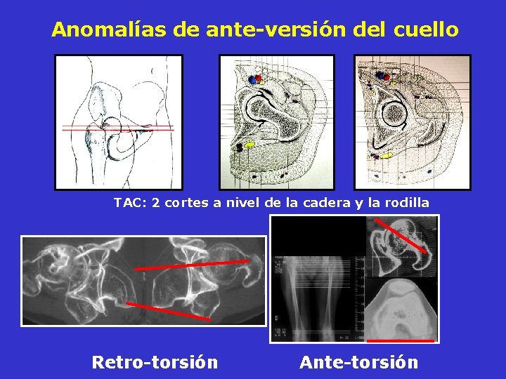 Anomalías de ante-versión del cuello TAC: 2 cortes a nivel de la cadera y Anomalías de ante-versión del cuello TAC: 2 cortes a nivel de la cadera y