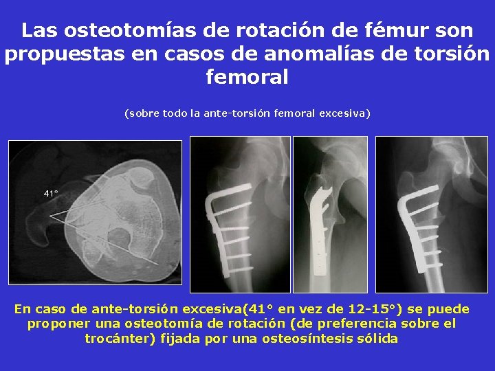 Las osteotomías de rotación de fémur son propuestas en casos de anomalías de torsión Las osteotomías de rotación de fémur son propuestas en casos de anomalías de torsión