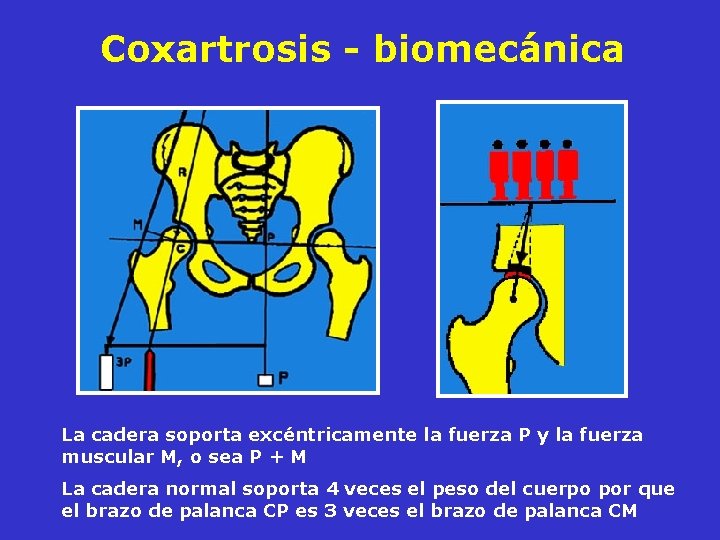 Coxartrosis - biomecánica La cadera soporta excéntricamente la fuerza P y la fuerza muscular Coxartrosis - biomecánica La cadera soporta excéntricamente la fuerza P y la fuerza muscular
