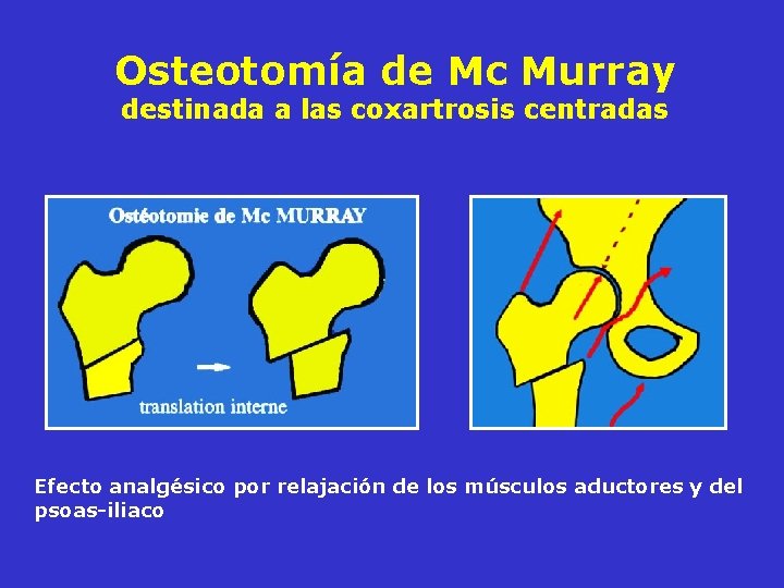 Osteotomía de Mc Murray destinada a las coxartrosis centradas Efecto analgésico por relajación de Osteotomía de Mc Murray destinada a las coxartrosis centradas Efecto analgésico por relajación de