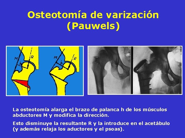 Osteotomía de varización (Pauwels) La osteotomía alarga el brazo de palanca h de los Osteotomía de varización (Pauwels) La osteotomía alarga el brazo de palanca h de los