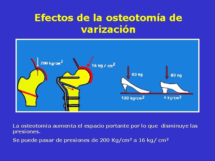 Efectos de la osteotomía de varización La osteotomía aumenta el espacio portante por lo Efectos de la osteotomía de varización La osteotomía aumenta el espacio portante por lo