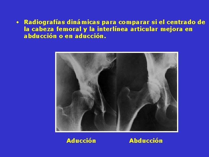 • Radiografías dinámicas para comparar si el centrado de la cabeza femoral y • Radiografías dinámicas para comparar si el centrado de la cabeza femoral y