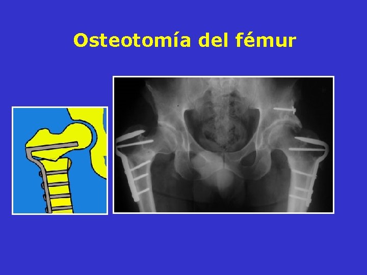 Osteotomía del fémur Osteotomía del fémur