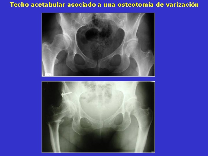 Techo acetabular asociado a una osteotomía de varización Techo acetabular asociado a una osteotomía de varización
