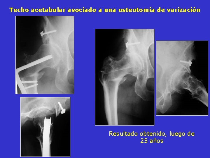 Techo acetabular asociado a una osteotomía de varización Resultado obtenido, luego de 25 años Techo acetabular asociado a una osteotomía de varización Resultado obtenido, luego de 25 años