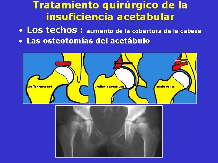 Tratamiento quirúrgico de la insuficiencia acetabular • Los techos : aumento de la cobertura Tratamiento quirúrgico de la insuficiencia acetabular • Los techos : aumento de la cobertura