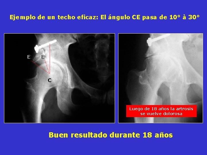 Ejemplo de un techo eficaz: El ángulo CE pasa de 10° à 30° E Ejemplo de un techo eficaz: El ángulo CE pasa de 10° à 30° E