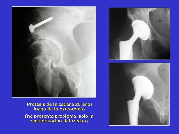 Prótesis de la cadera 20 años luego de la osteotomía (no presenta problema, Prótesis de la cadera 20 años luego de la osteotomía (no presenta problema,