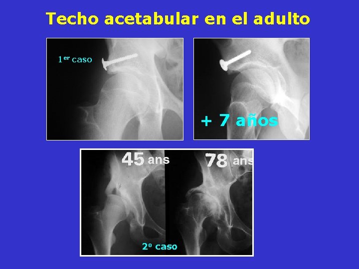 Techo acetabular en el adulto 1 er caso + 7 años 2 o caso Techo acetabular en el adulto 1 er caso + 7 años 2 o caso