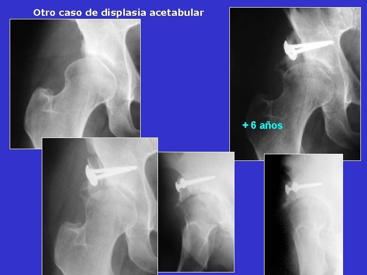 Otro caso de displasia acetabular + 6 años Otro caso de displasia acetabular + 6 años