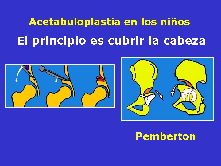 Acetabuloplastia en los niños El principio es cubrir la cabeza Pemberton Acetabuloplastia en los niños El principio es cubrir la cabeza Pemberton