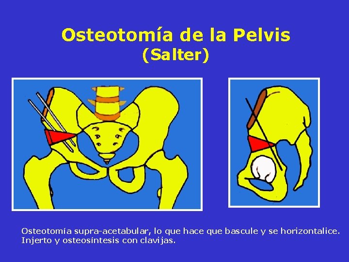 Osteotomía de la Pelvis (Salter) Osteotomía supra-acetabular, lo que hace que bascule y se Osteotomía de la Pelvis (Salter) Osteotomía supra-acetabular, lo que hace que bascule y se
