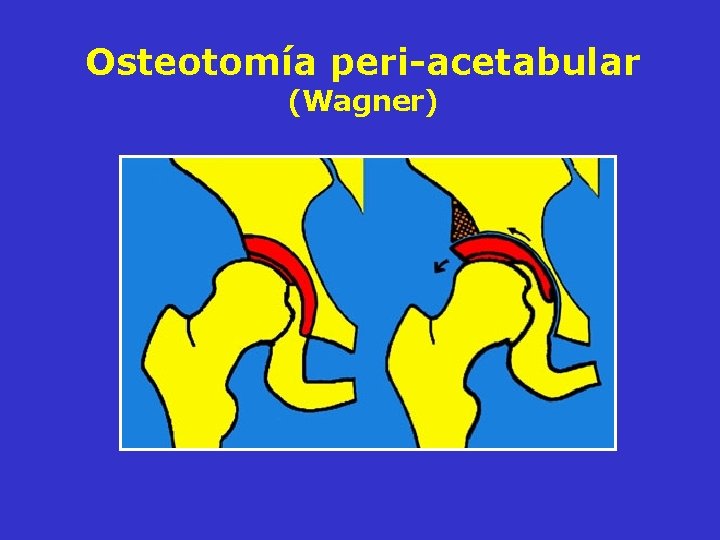 Osteotomía peri-acetabular (Wagner) Osteotomía peri-acetabular (Wagner)