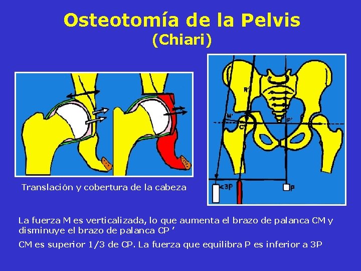 Osteotomía de la Pelvis (Chiari) Translación y cobertura de la cabeza La fuerza M Osteotomía de la Pelvis (Chiari) Translación y cobertura de la cabeza La fuerza M