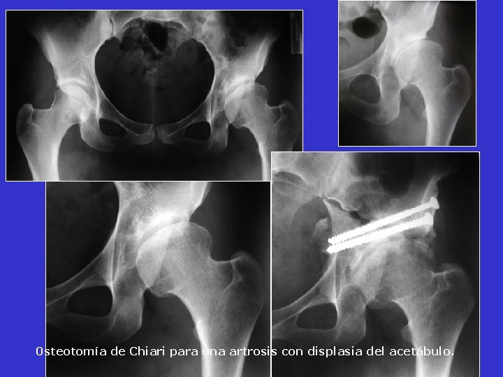 0 steotomía de Chiari para una artrosis con displasia del acetábulo. 0 steotomía de Chiari para una artrosis con displasia del acetábulo.