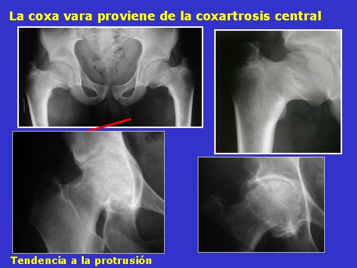 La coxa vara proviene de la coxartrosis central Tendencia a la protrusión La coxa vara proviene de la coxartrosis central Tendencia a la protrusión
