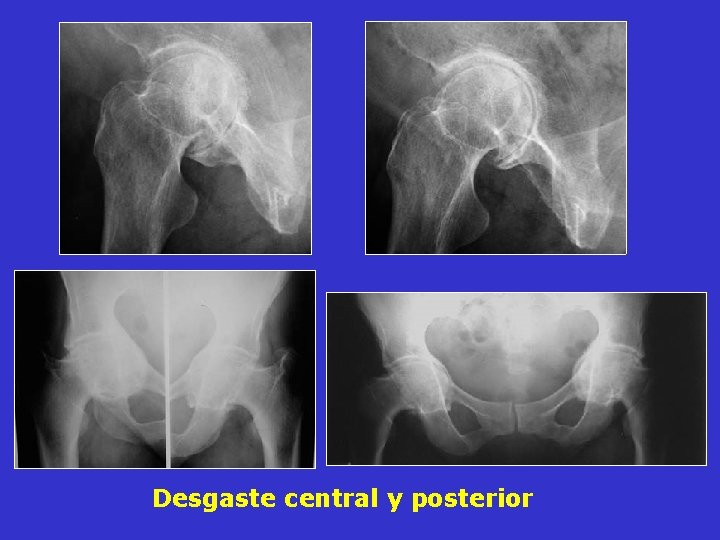 Desgaste central y posterior Desgaste central y posterior