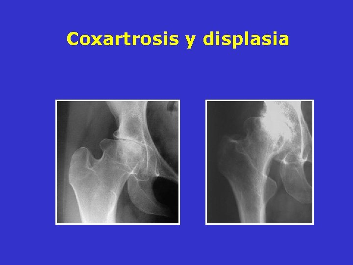Coxartrosis y displasia Coxartrosis y displasia