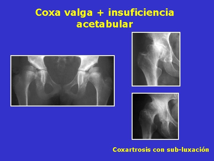 Coxa valga + insuficiencia acetabular Coxartrosis con sub-luxación Coxa valga + insuficiencia acetabular Coxartrosis con sub-luxación