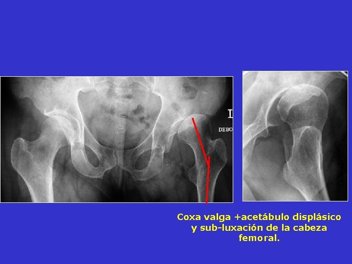 Coxa valga +acetábulo displásico y sub-luxación de la cabeza femoral. Coxa valga +acetábulo displásico y sub-luxación de la cabeza femoral.