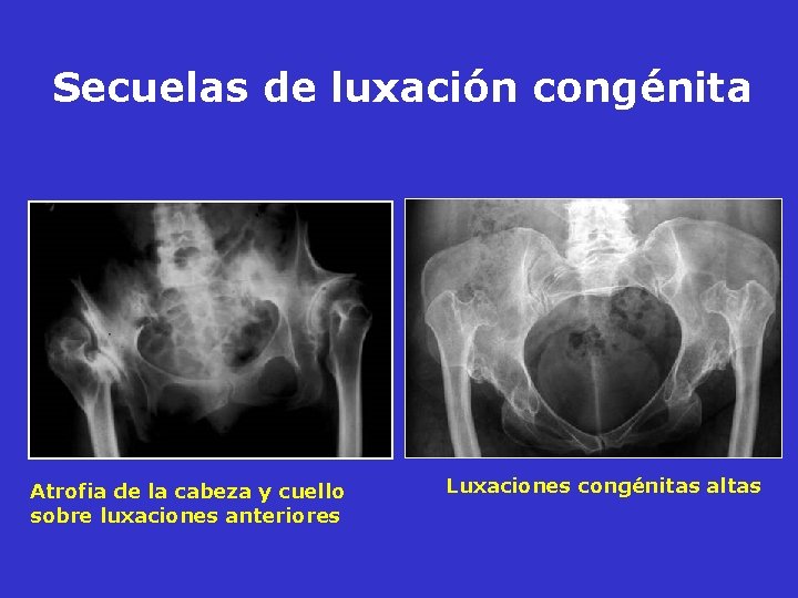 Secuelas de luxación congénita Atrofia de la cabeza y cuello sobre luxaciones anteriores Luxaciones Secuelas de luxación congénita Atrofia de la cabeza y cuello sobre luxaciones anteriores Luxaciones