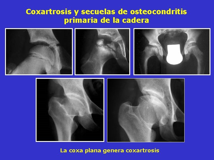 Coxartrosis y secuelas de osteocondritis primaria de la cadera La coxa plana genera coxartrosis Coxartrosis y secuelas de osteocondritis primaria de la cadera La coxa plana genera coxartrosis