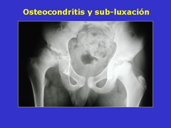 Osteocondritis y sub-luxación Osteocondritis y sub-luxación