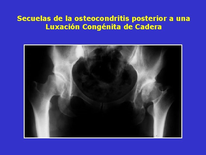 Secuelas de la osteocondritis posterior a una Luxación Congénita de Cadera Secuelas de la osteocondritis posterior a una Luxación Congénita de Cadera