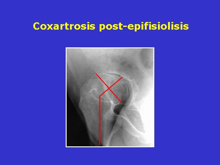 Coxartrosis post-epifisiolisis Coxartrosis post-epifisiolisis