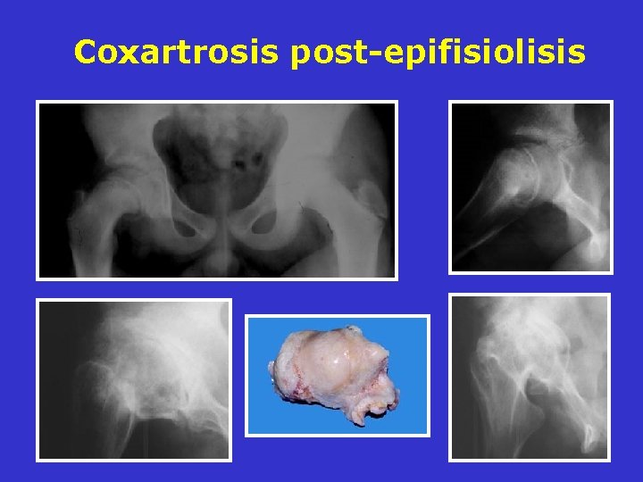 Coxartrosis post-epifisiolisis Coxartrosis post-epifisiolisis