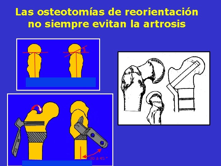 Las osteotomías de reorientación no siempre evitan la artrosis Las osteotomías de reorientación no siempre evitan la artrosis