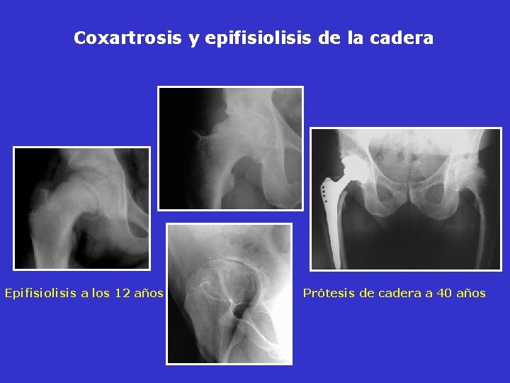 Coxartrosis y epifisiolisis de la cadera Epifisiolisis a los 12 años Prótesis de cadera Coxartrosis y epifisiolisis de la cadera Epifisiolisis a los 12 años Prótesis de cadera