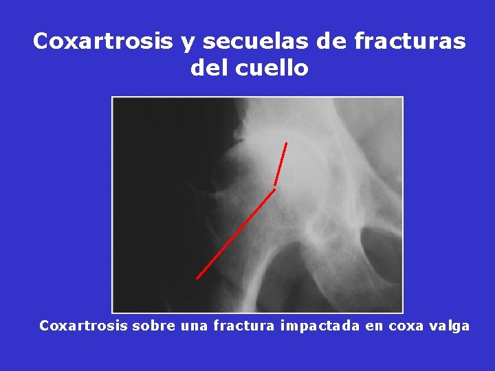 Coxartrosis y secuelas de fracturas del cuello Coxartrosis sobre una fractura impactada en coxa Coxartrosis y secuelas de fracturas del cuello Coxartrosis sobre una fractura impactada en coxa