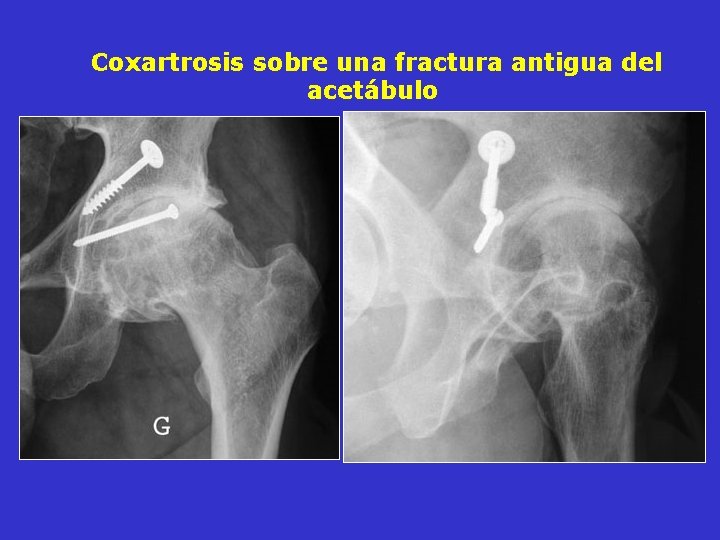 Coxartrosis sobre una fractura antigua del acetábulo Coxartrosis sobre una fractura antigua del acetábulo