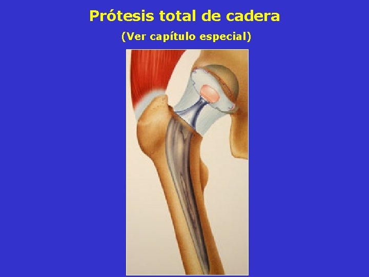 Prótesis total de cadera (Ver capítulo especial) Prótesis total de cadera (Ver capítulo especial)