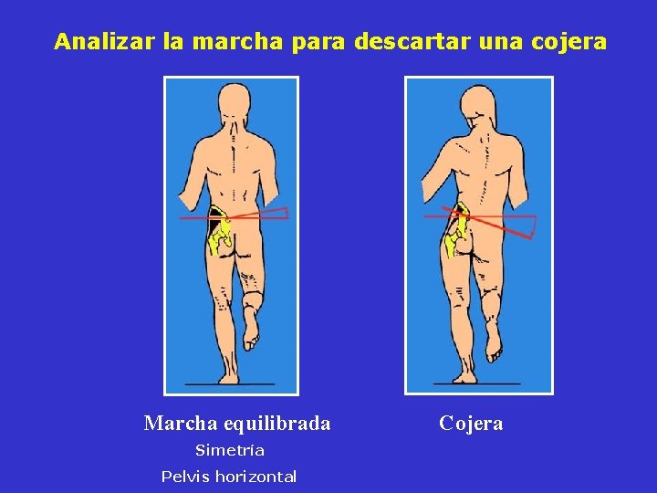 Analizar la marcha para descartar una cojera Marcha equilibrada Simetría Pelvis horizontal Cojera Analizar la marcha para descartar una cojera Marcha equilibrada Simetría Pelvis horizontal Cojera