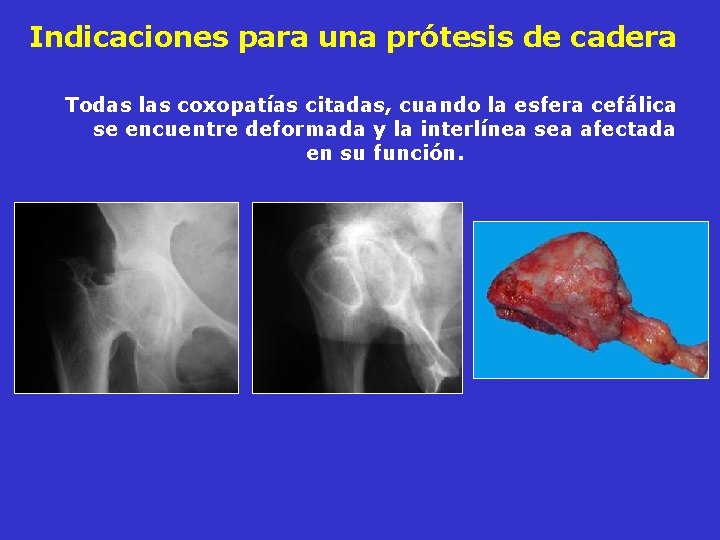 Indicaciones para una prótesis de cadera Todas las coxopatías citadas, cuando la esfera cefálica Indicaciones para una prótesis de cadera Todas las coxopatías citadas, cuando la esfera cefálica