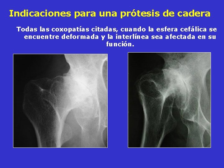 Indicaciones para una prótesis de cadera Todas las coxopatías citadas, cuando la esfera cefálica Indicaciones para una prótesis de cadera Todas las coxopatías citadas, cuando la esfera cefálica