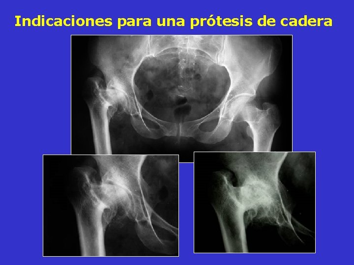 Indicaciones para una prótesis de cadera Indicaciones para una prótesis de cadera