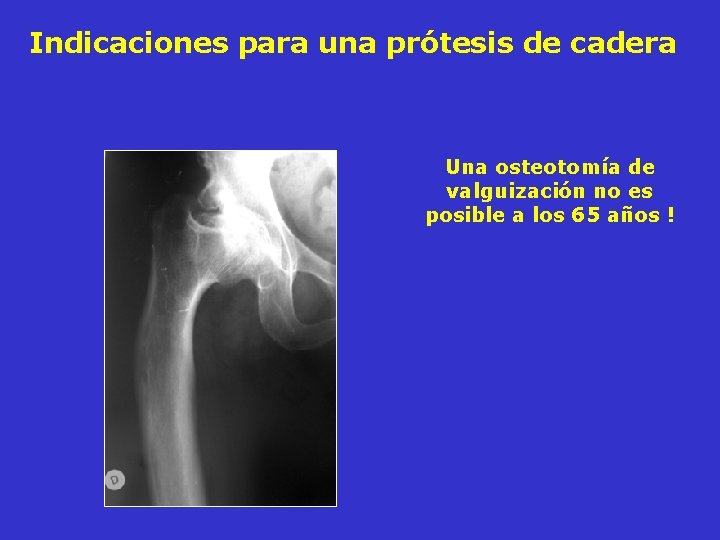 Indicaciones para una prótesis de cadera Una osteotomía de valguización no es posible a Indicaciones para una prótesis de cadera Una osteotomía de valguización no es posible a