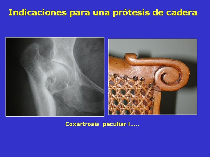 Indicaciones para una prótesis de cadera Coxartrosis peculiar !…. . Indicaciones para una prótesis de cadera Coxartrosis peculiar !…. .