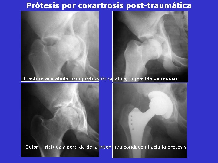 Prótesis por coxartrosis post-traumática Fractura acetabular con protrusión cefálica, imposible de reducir Dolor + Prótesis por coxartrosis post-traumática Fractura acetabular con protrusión cefálica, imposible de reducir Dolor +