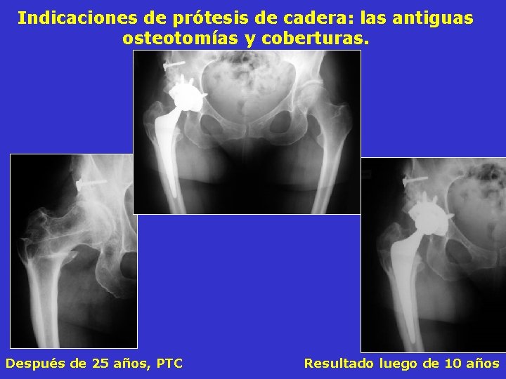 Indicaciones de prótesis de cadera: las antiguas osteotomías y coberturas. Después de 25 años, Indicaciones de prótesis de cadera: las antiguas osteotomías y coberturas. Después de 25 años,